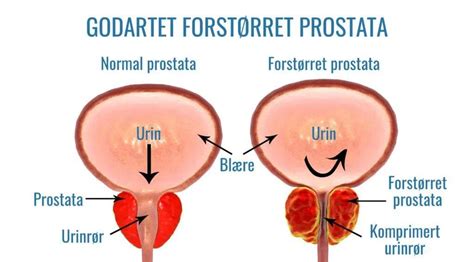 Betændelse i prostata symptomer